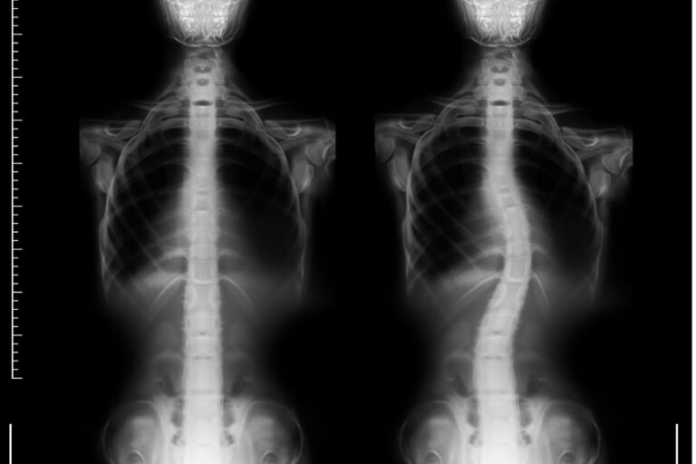 CST & Scoliosis – a personal experience
